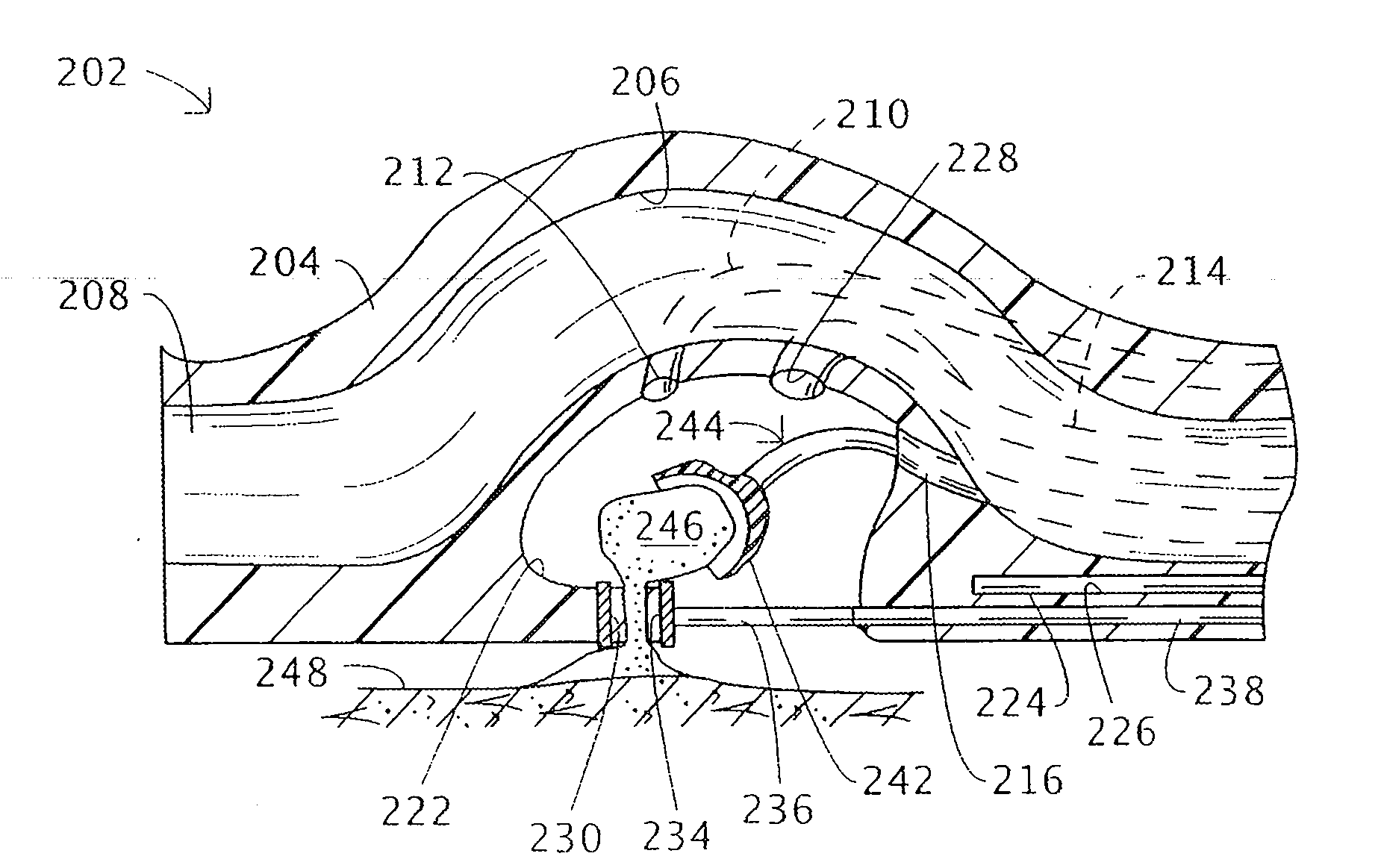 Endoluminal treatment method and associated surgical assembly including tissue occlusion device