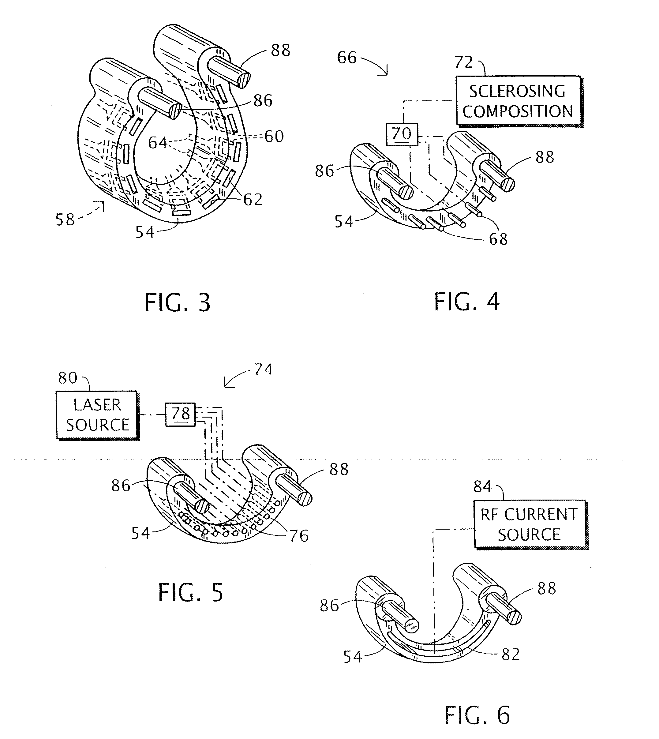 Endoluminal treatment method and associated surgical assembly including tissue occlusion device