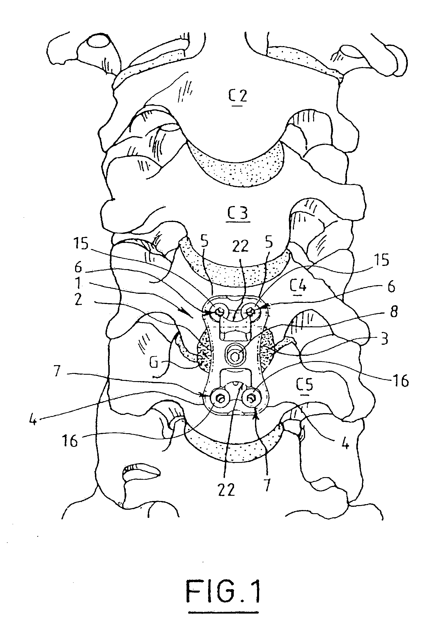 Anterior implant for the spine