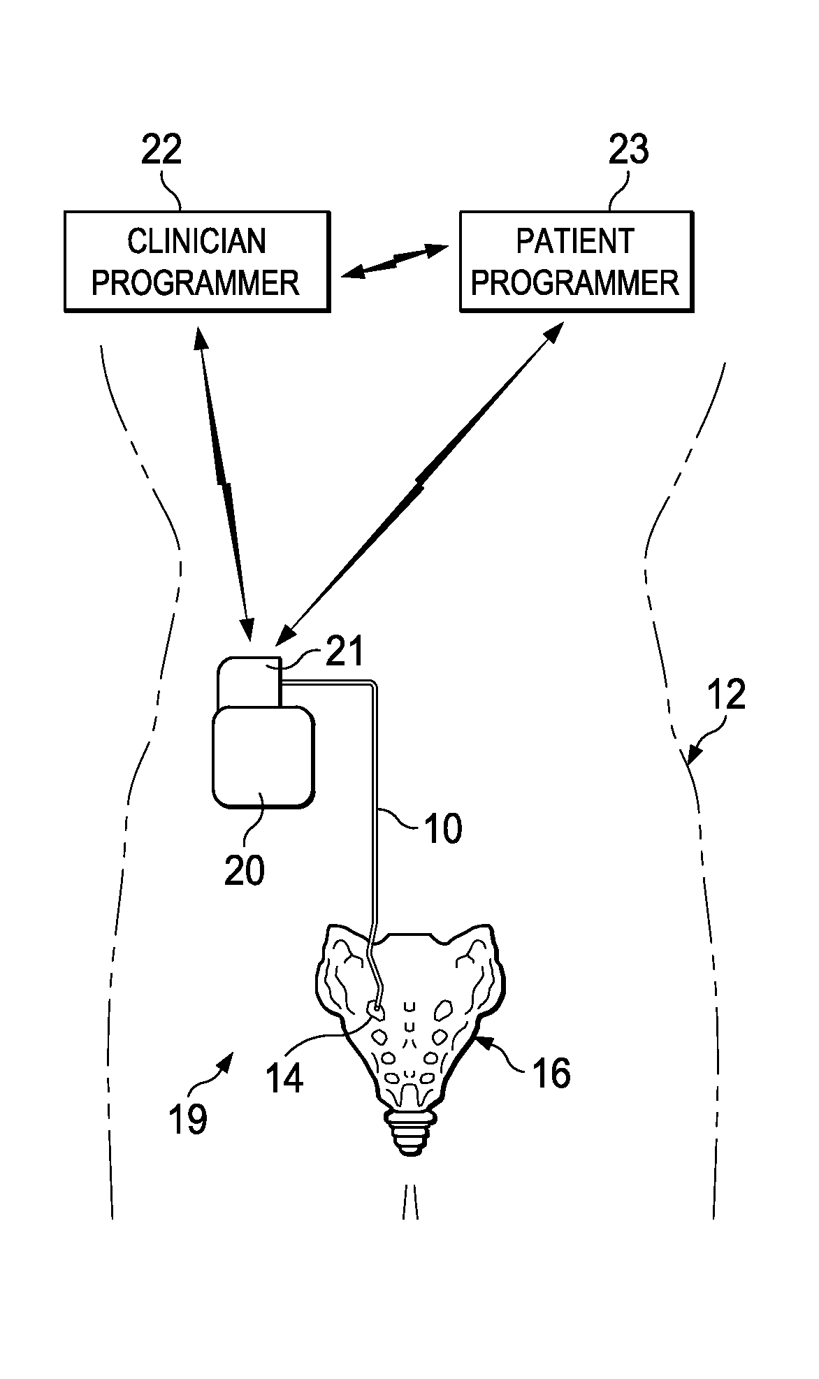 Ipg configured to deliver different pulse regimes to different leads for pudendal nerve stimulation