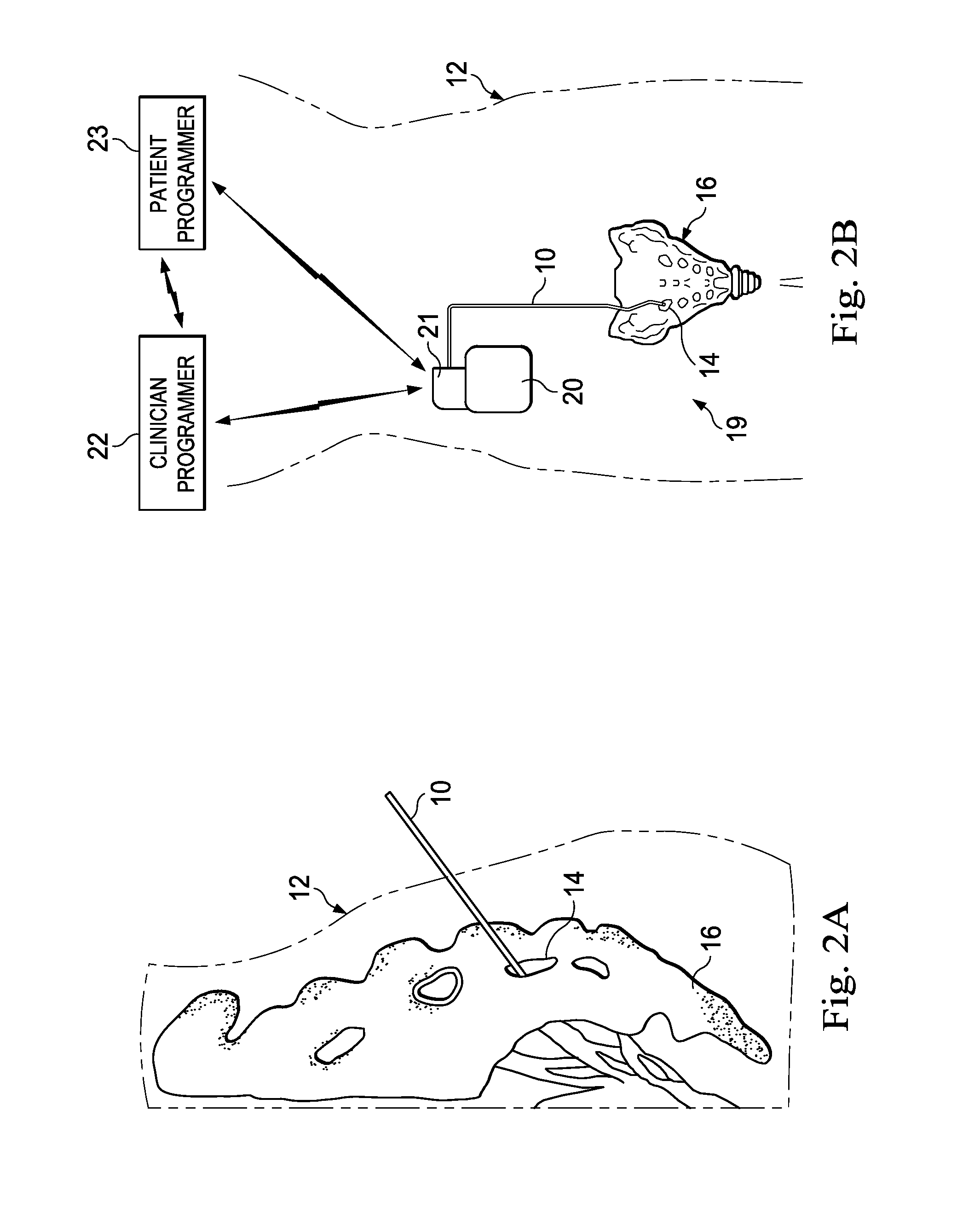 Ipg configured to deliver different pulse regimes to different leads for pudendal nerve stimulation