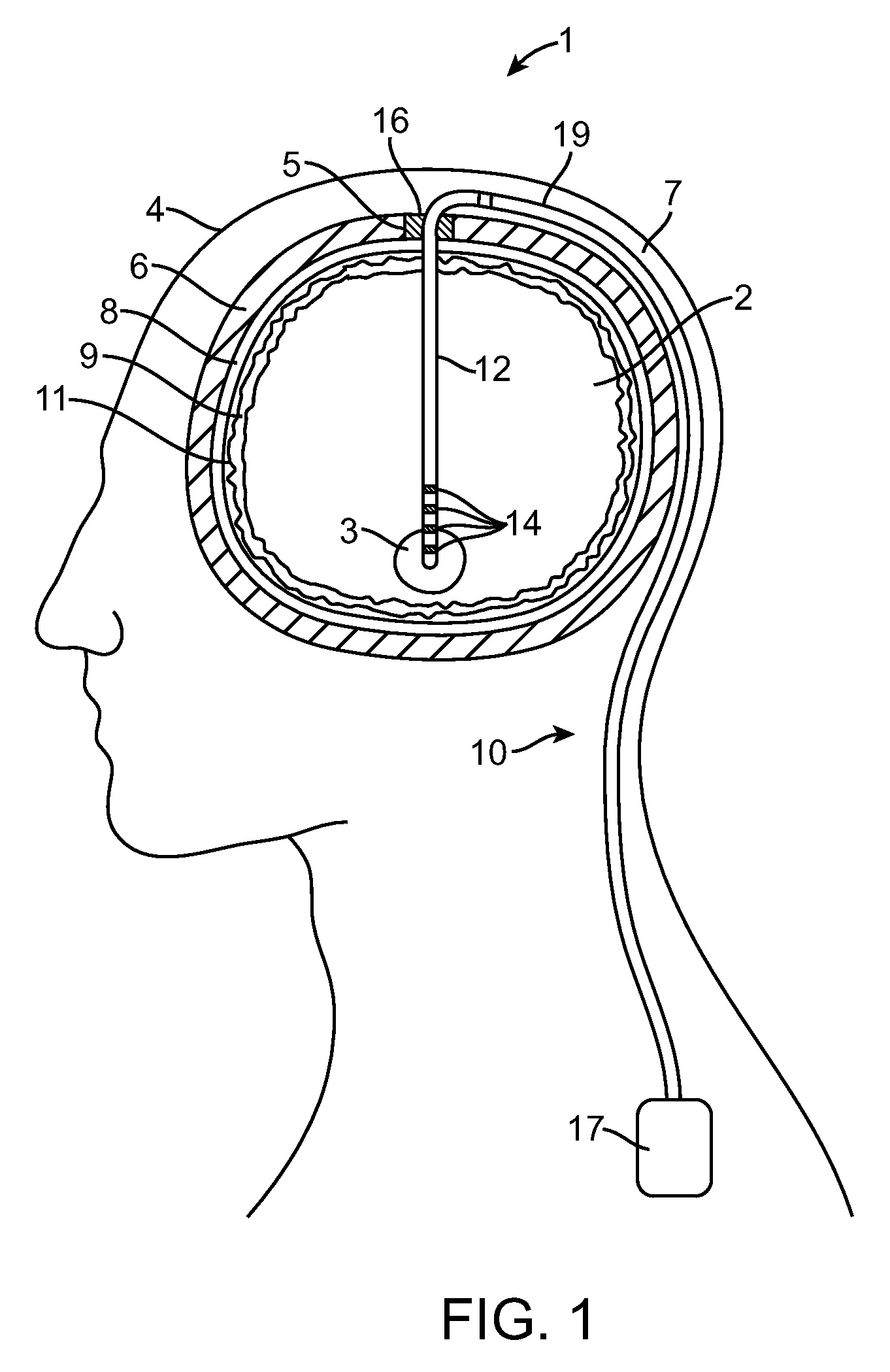 Burr hole sealing device for preventing brain shift