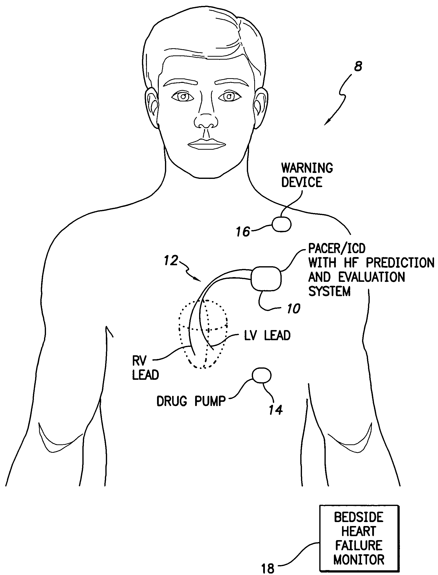 System and method for predicting a heart condition based on impedance values using an implantable medical device