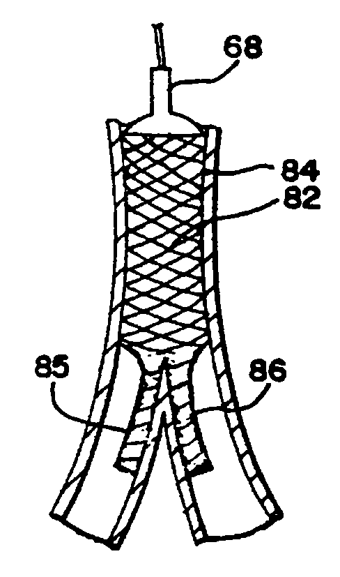 Expandable supportive branched endoluminal grafts