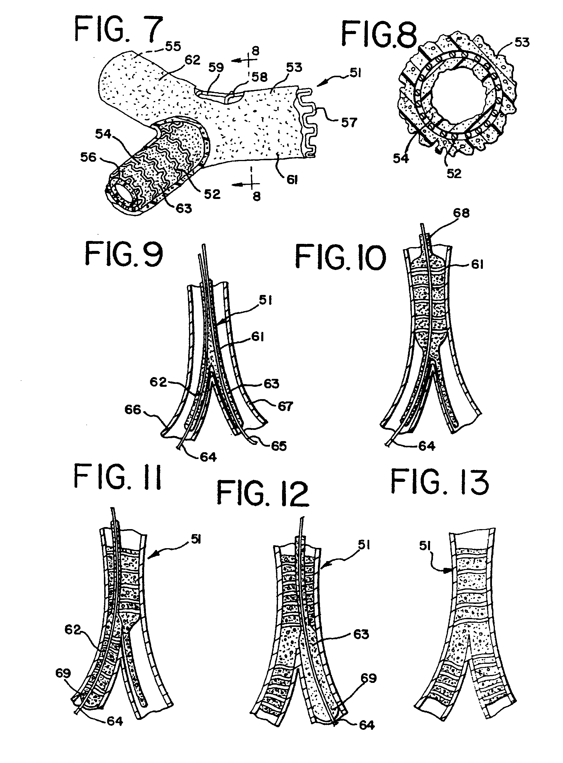 Expandable supportive branched endoluminal grafts