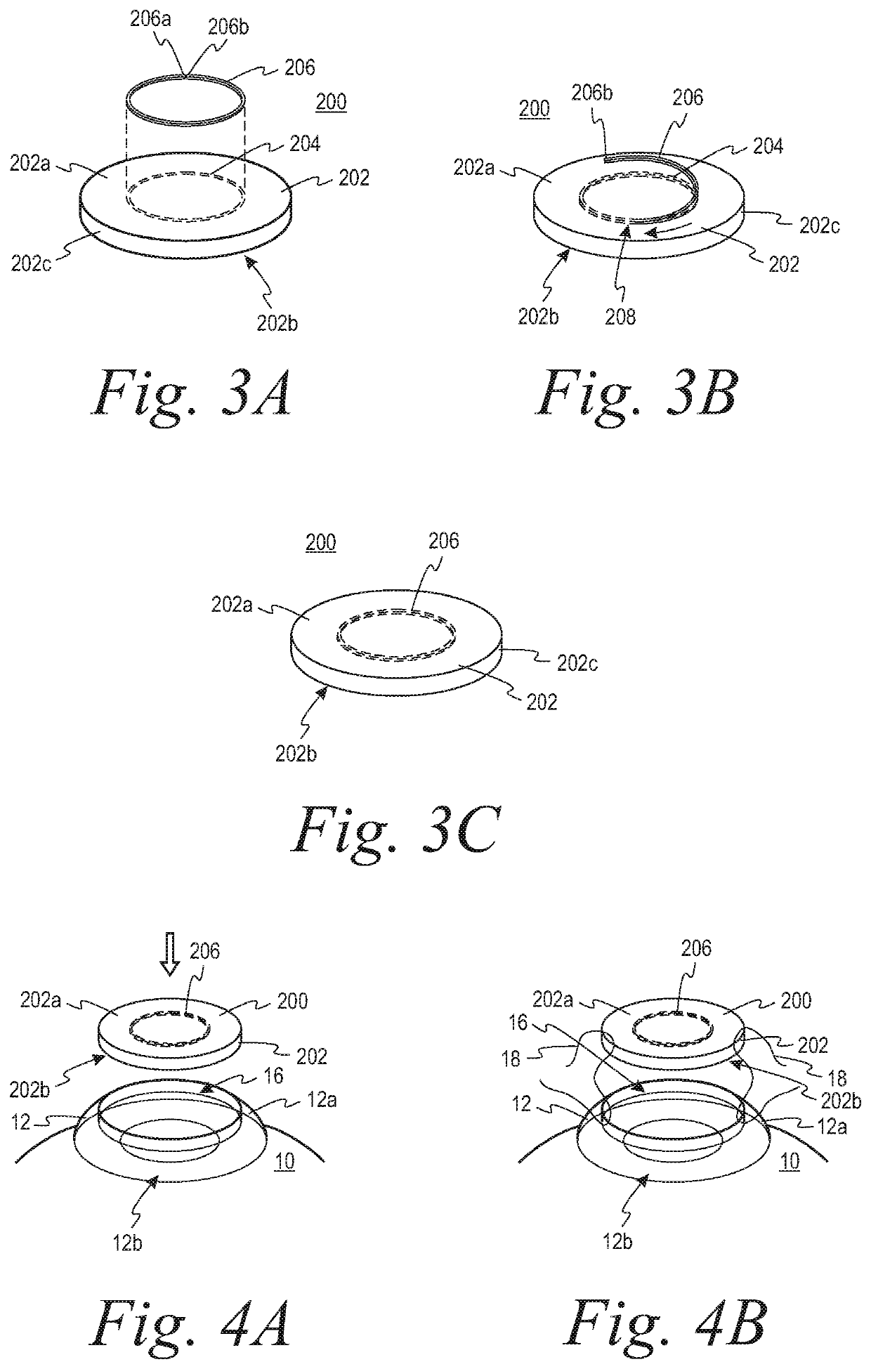 Systems and methods for corneal transplants