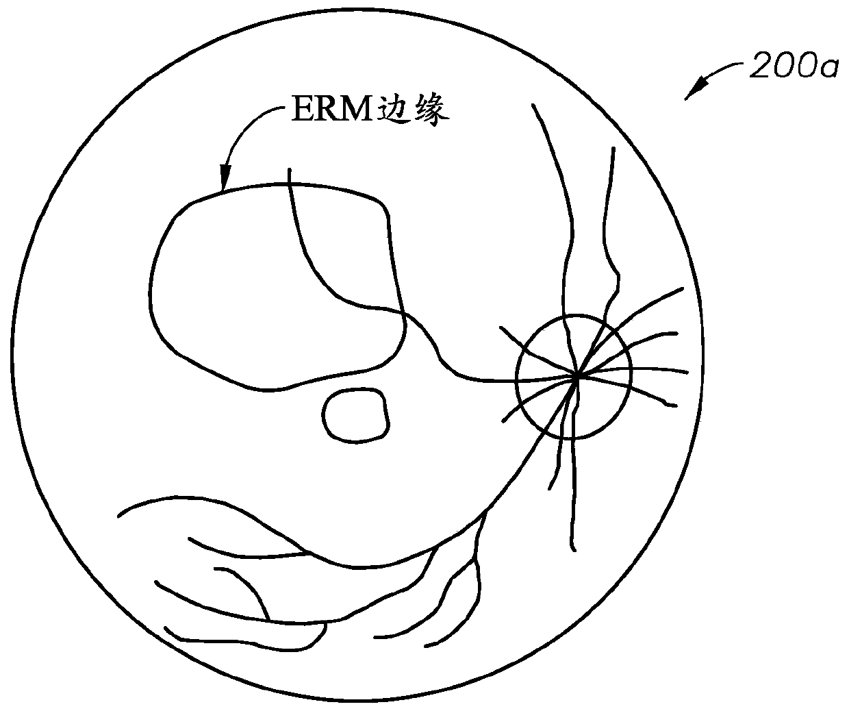 Epiretinal membrane peeling guided by optical coherence tomography