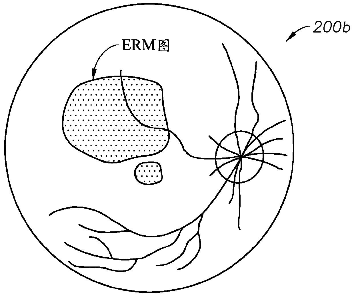 Epiretinal membrane peeling guided by optical coherence tomography