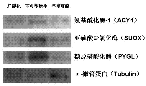 Molecular markers of early liver cancer and application of makers