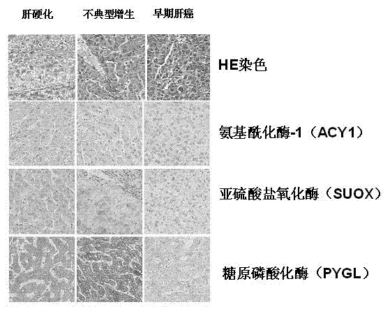 Molecular markers of early liver cancer and application of makers