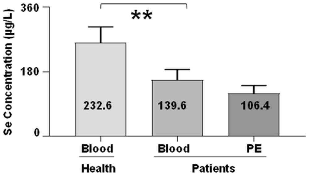 Lentinan nano-selenium, preparation method and application of lentinan nano-selenium in treating malignant pleural effusion