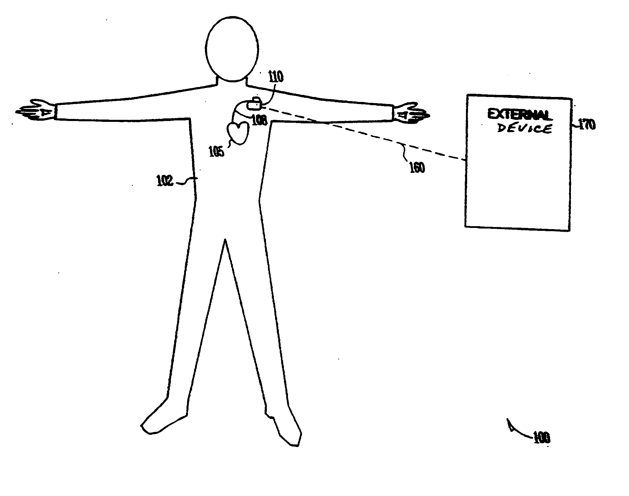 Therapy control based on the rate of change of intracardiac impedance