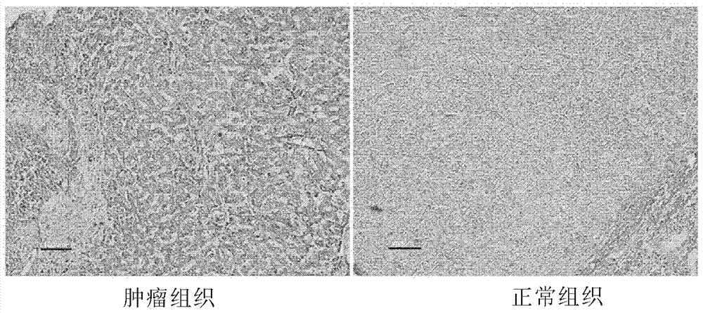 Marker for diagnosing liver cancer and application thereof