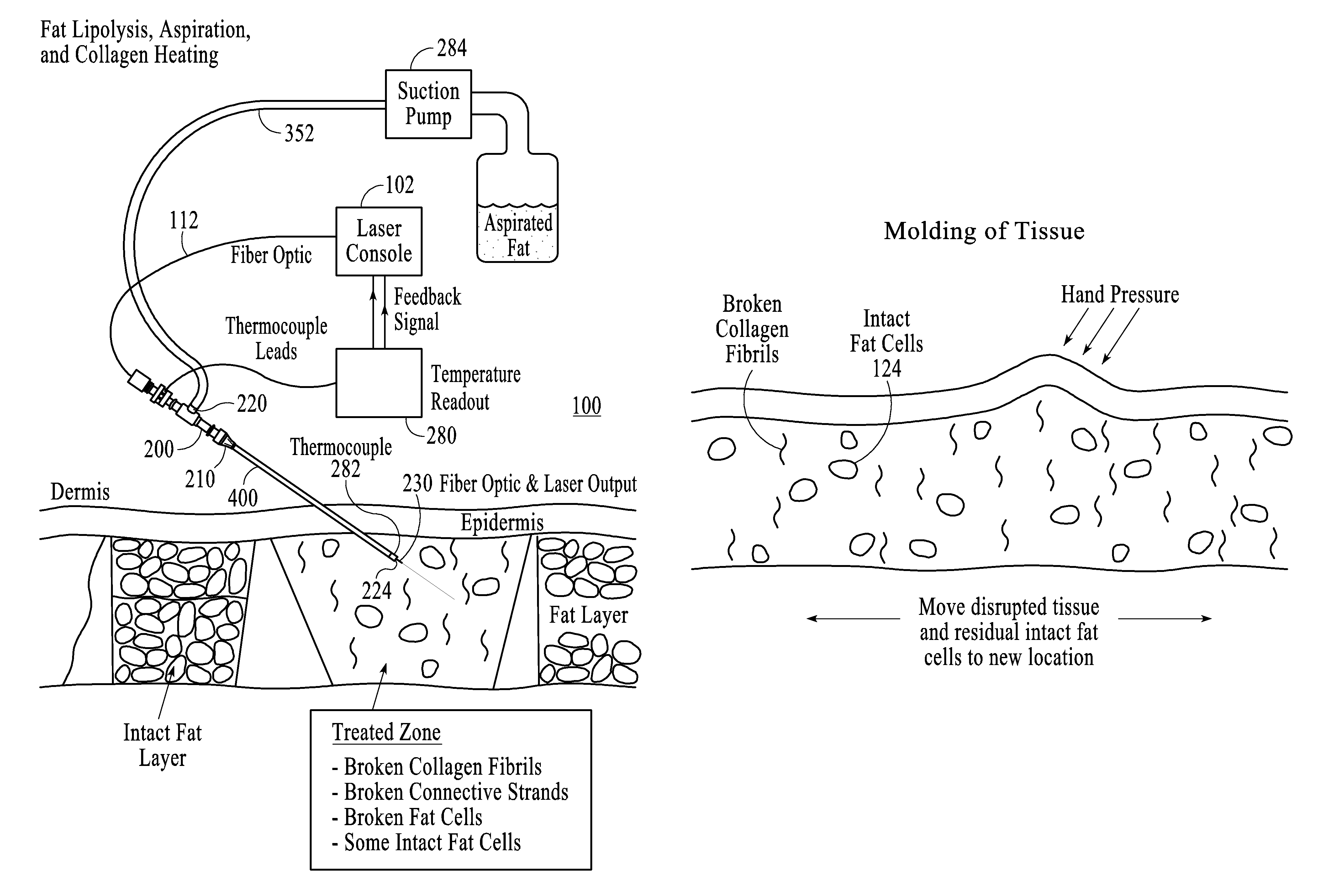 Thermally mediated tissue molding