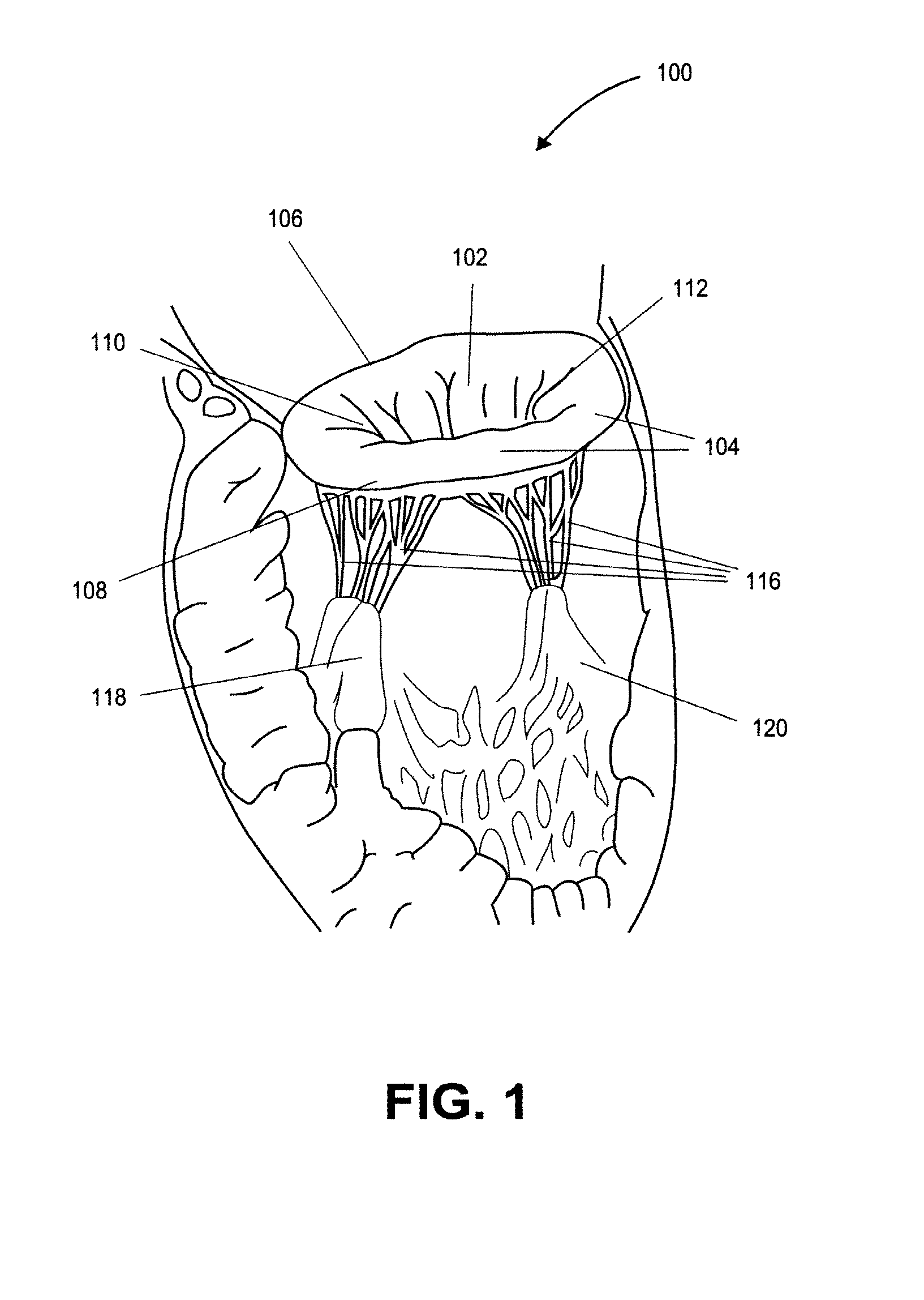 Heart valve prosthesis with collapsible valve and method of delivery thereof