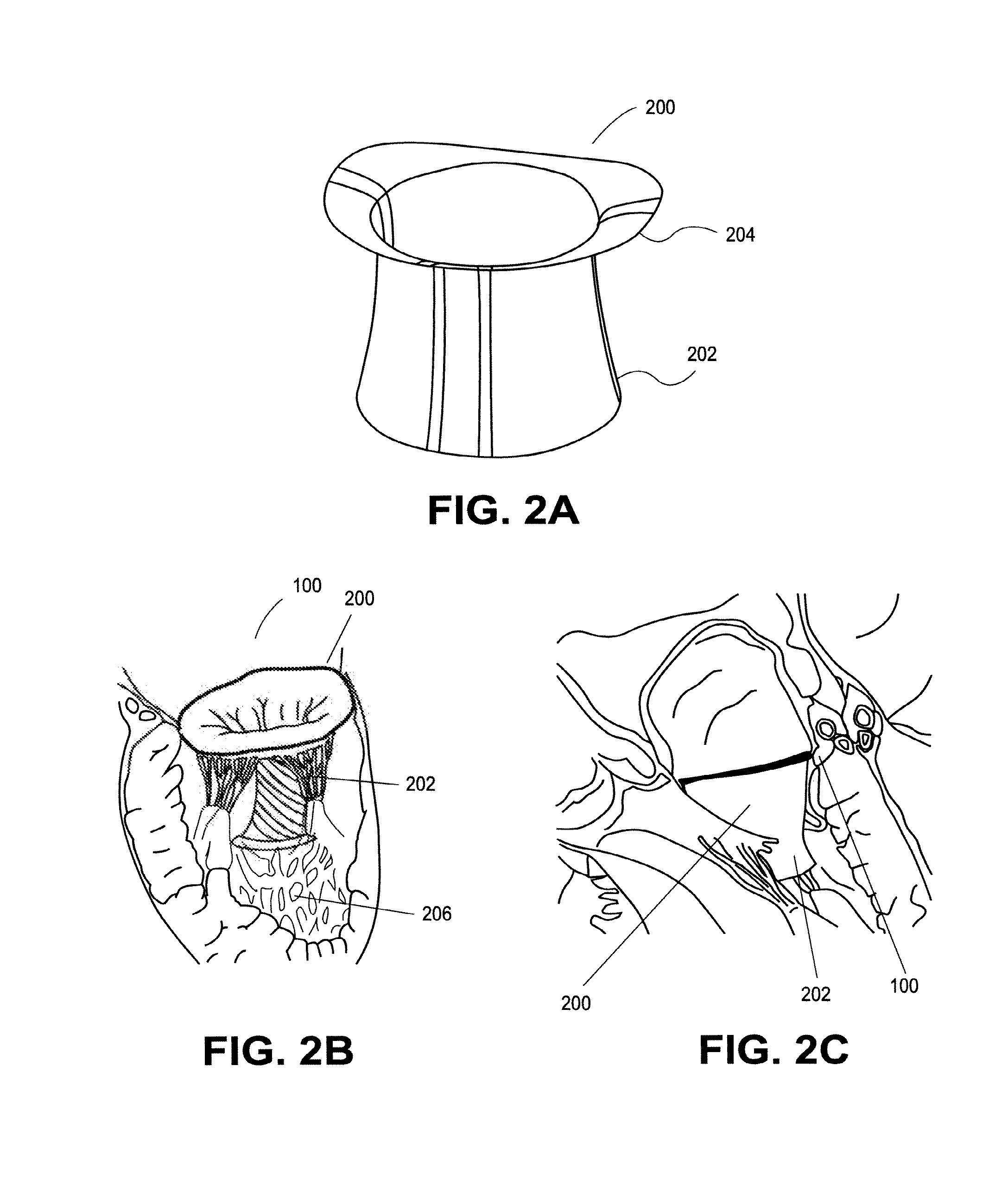 Heart valve prosthesis with collapsible valve and method of delivery thereof