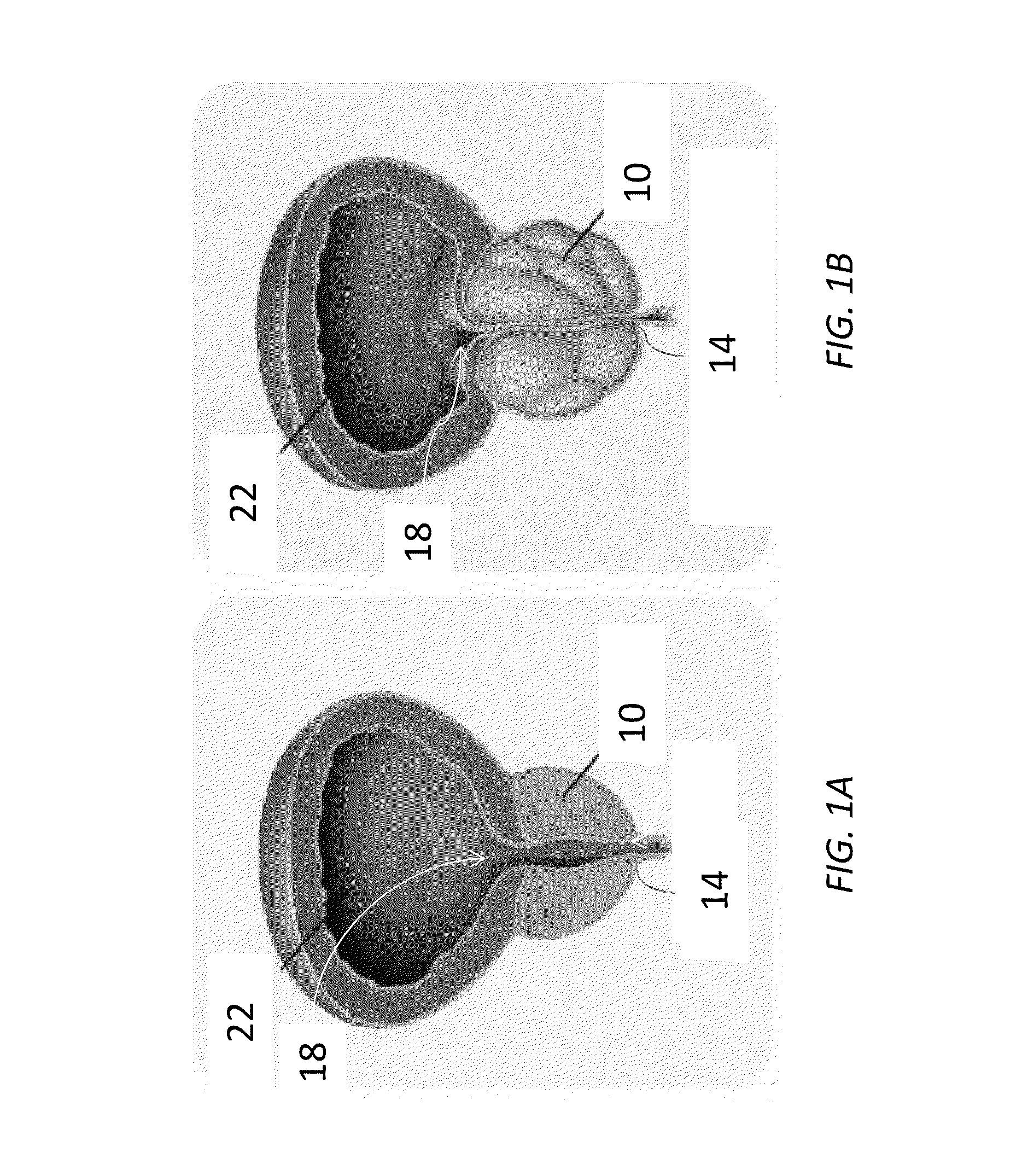 Urethral patency implant