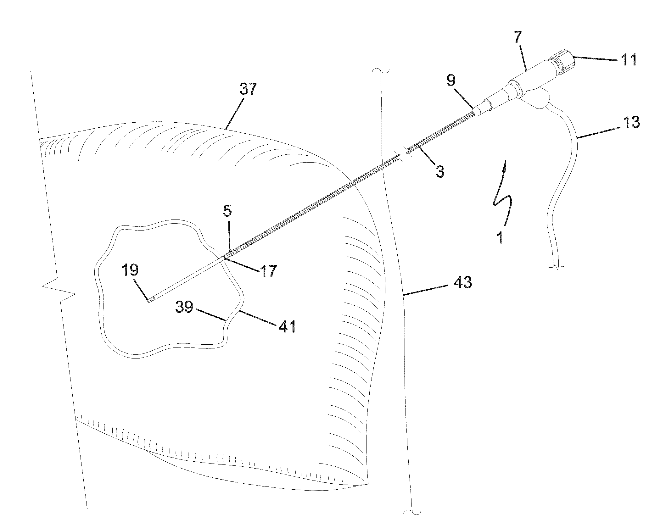 Flexible medical ablation device and method of use