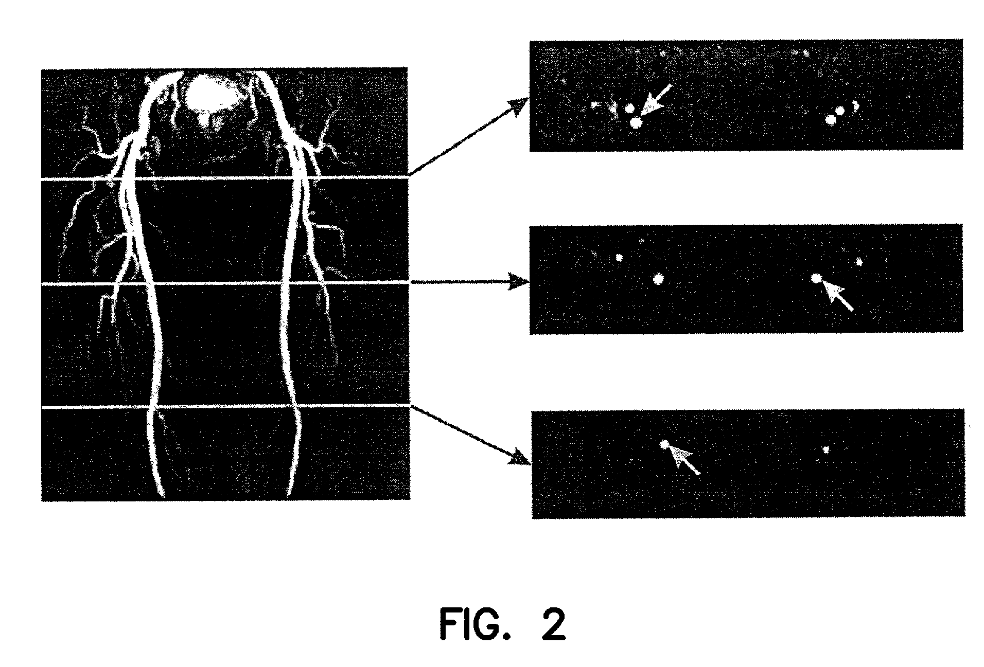 Method and apparatus for anatomically tailored k-space sampling and recessed elliptical view ordering for bolus-enhanced 3D MR angiography