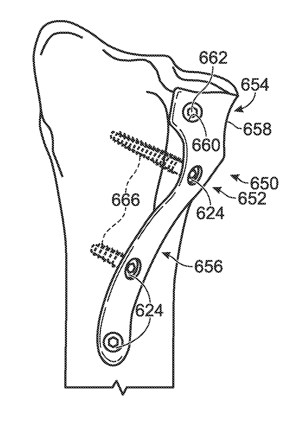 Partial or complete prosthetic replacement arthroplasty of the distal radioulnar joint