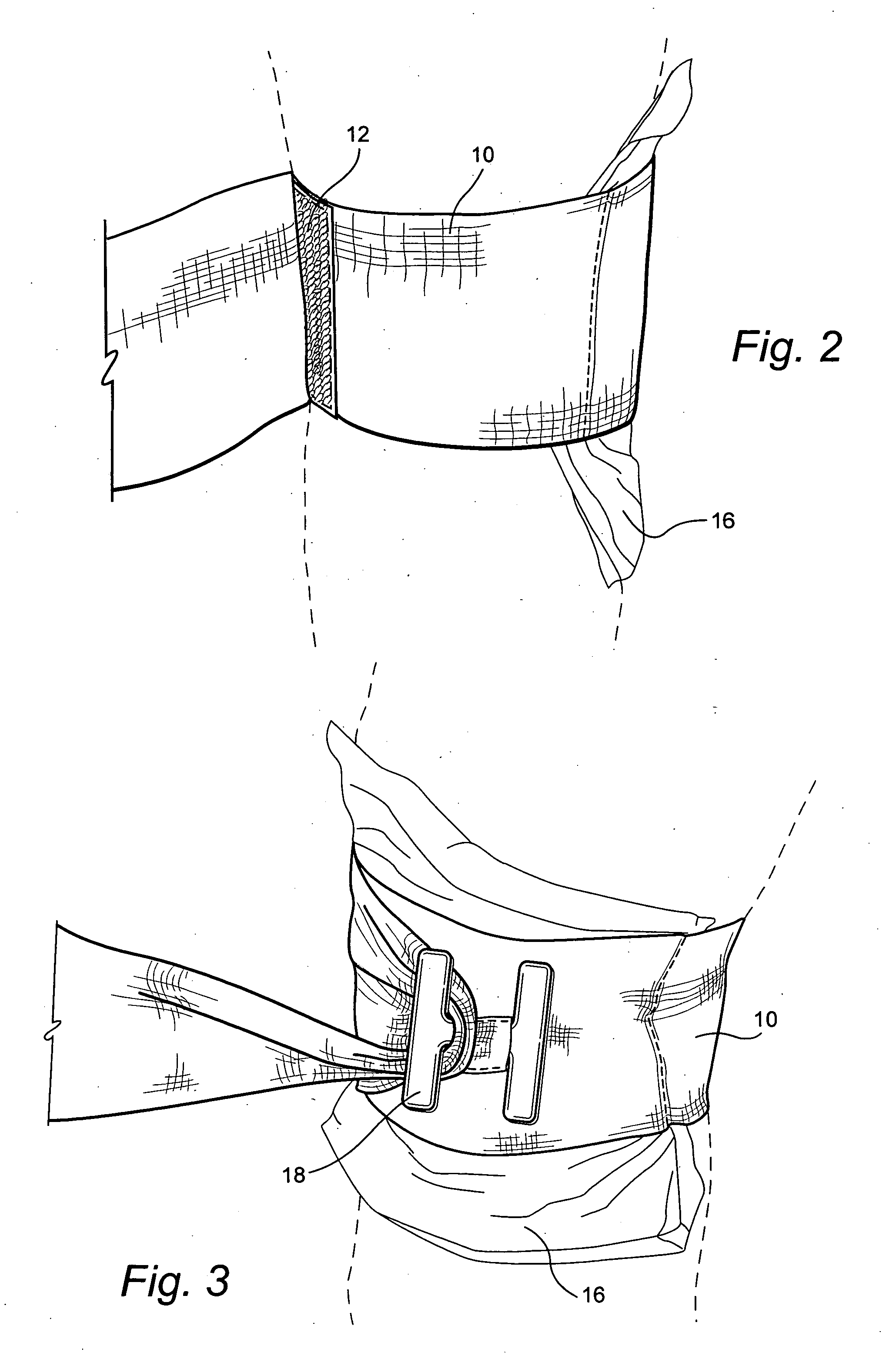 Compression bandage with H-anchor tightening means