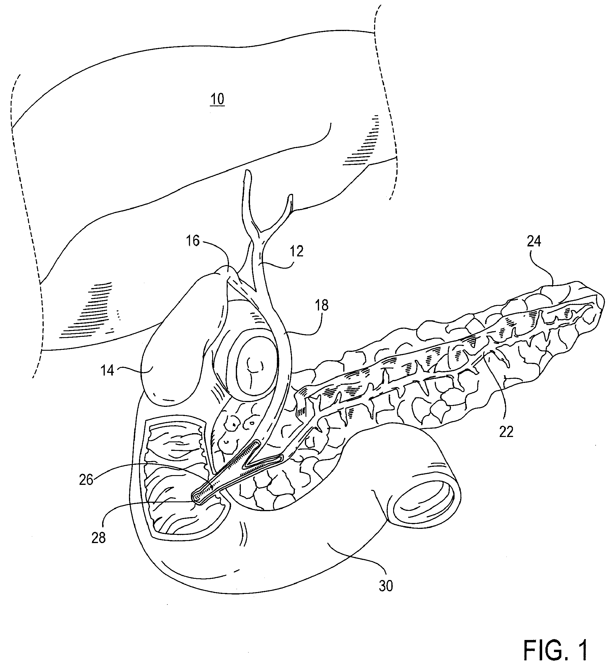 Methods, Devices, Kits and Systems for Defunctionalizing the Cystic Duct