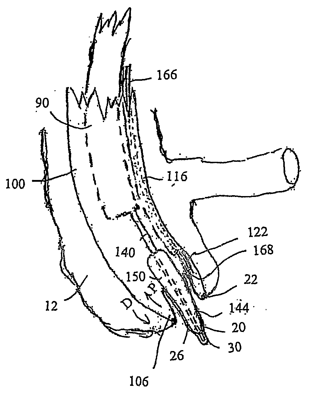 Apparatus and method for colonoscopic appendectomy