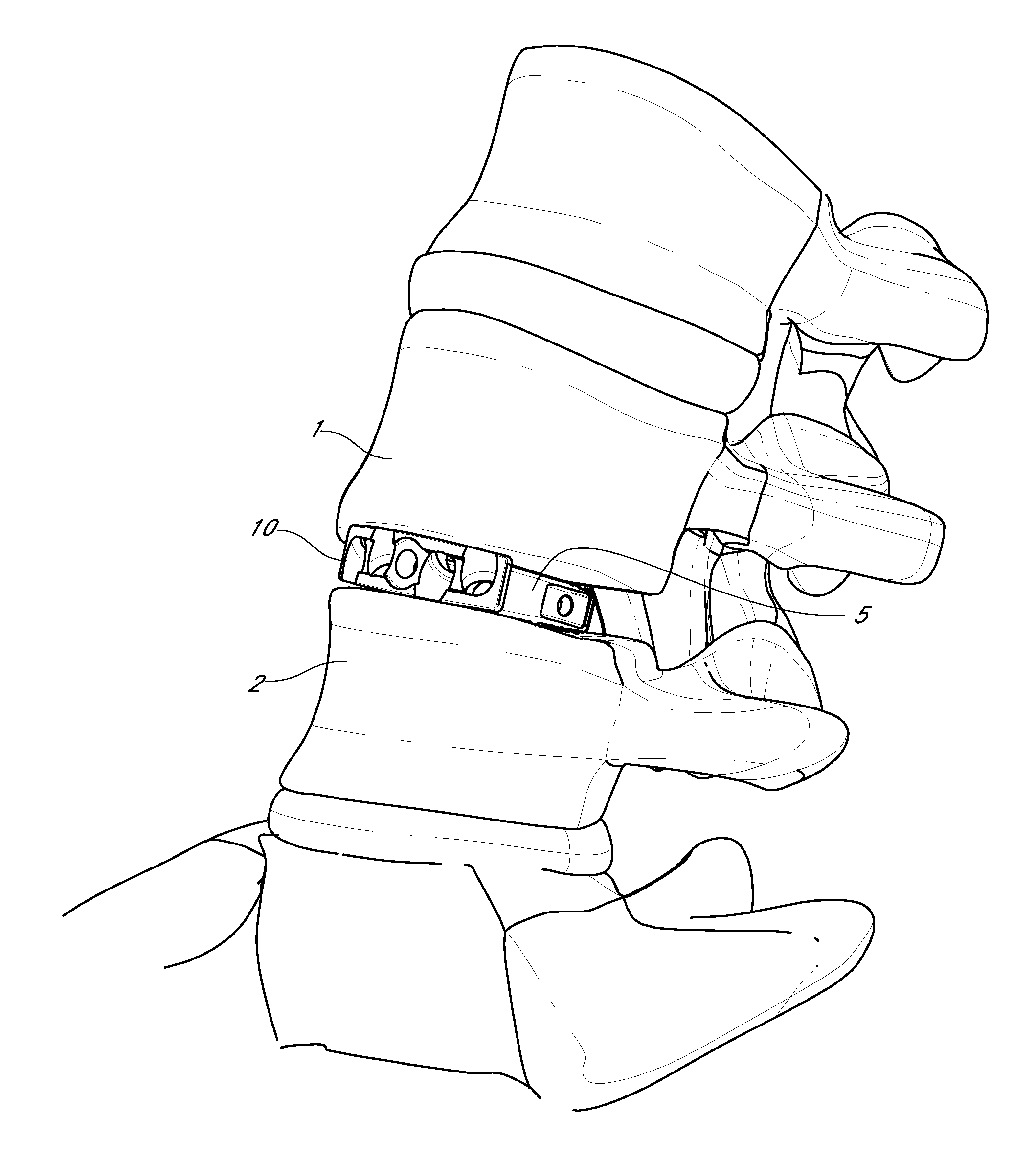 Intervertebral plate system