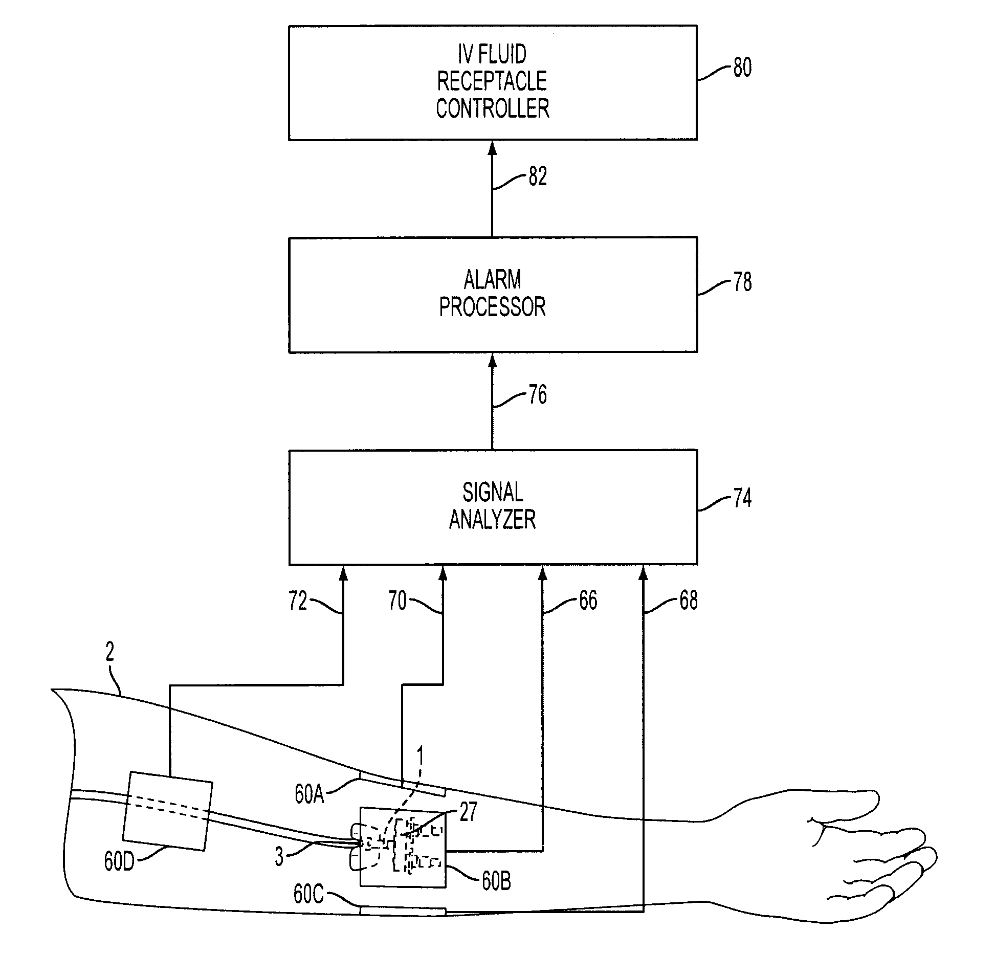 Intravenous infiltration detection