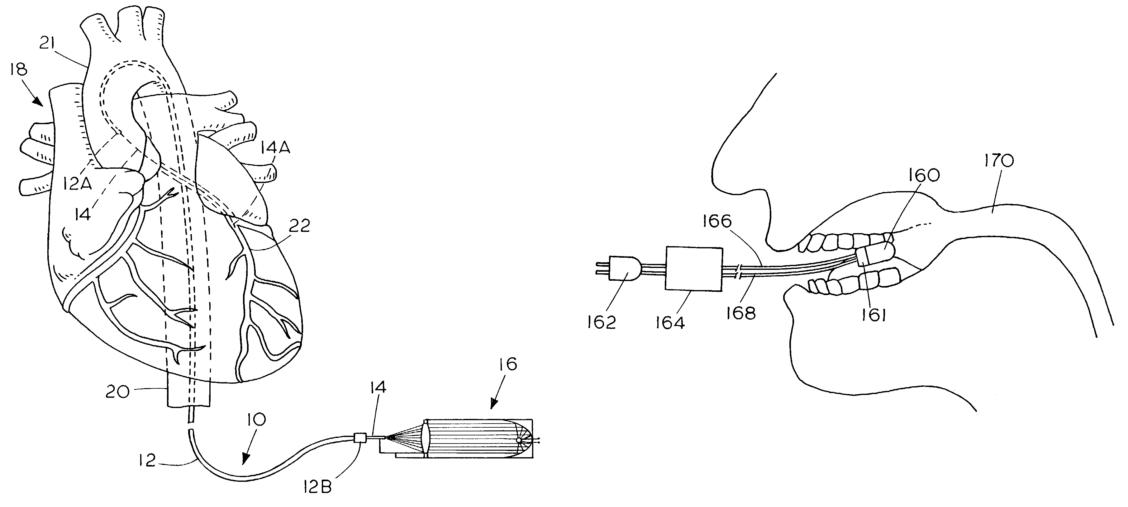 Apparatus and method for treating atherosclerotic vascular disease through light sterilization