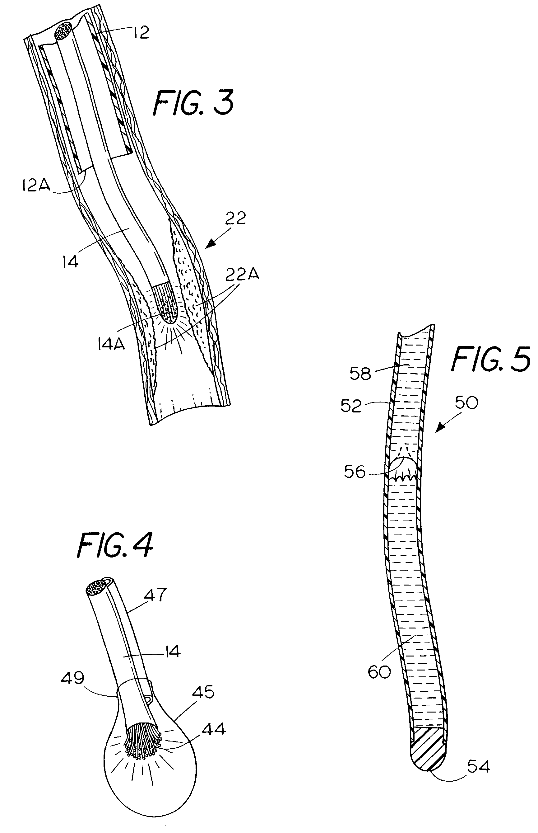 Apparatus and method for treating atherosclerotic vascular disease through light sterilization