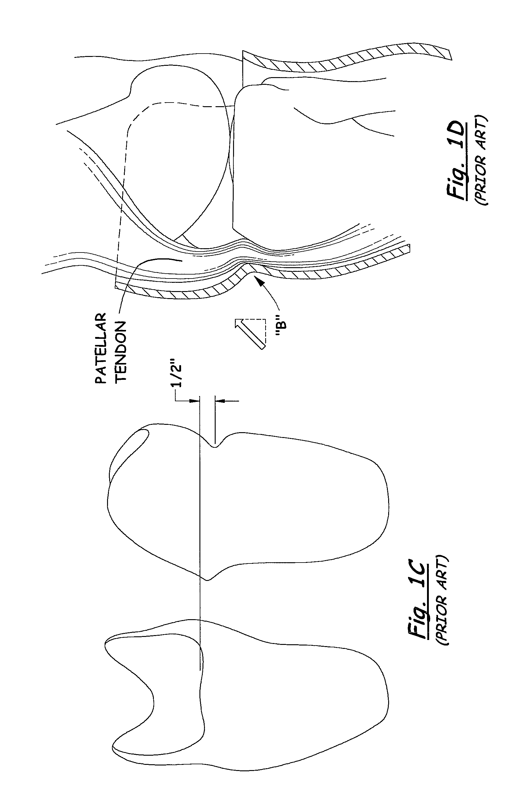 Transtibial socket for external prosthesis