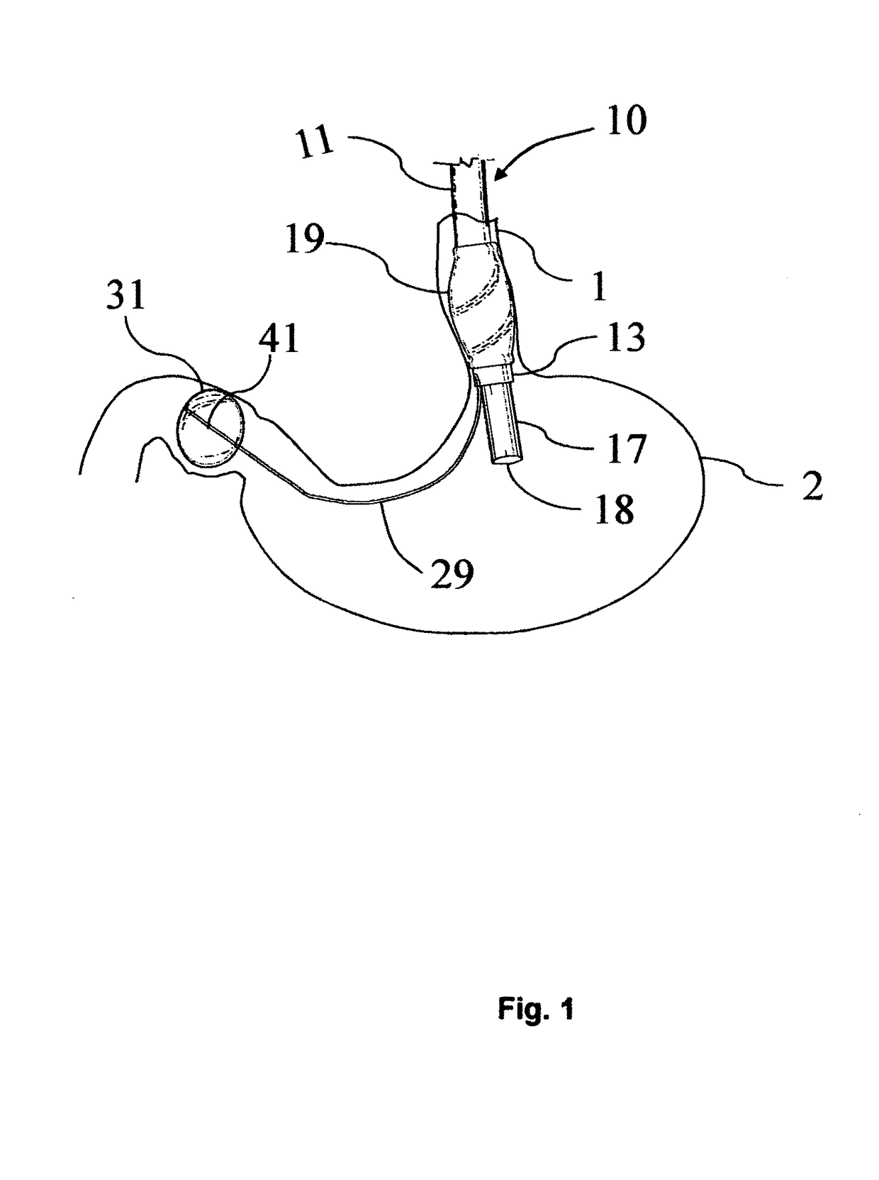 Endoscope accessory