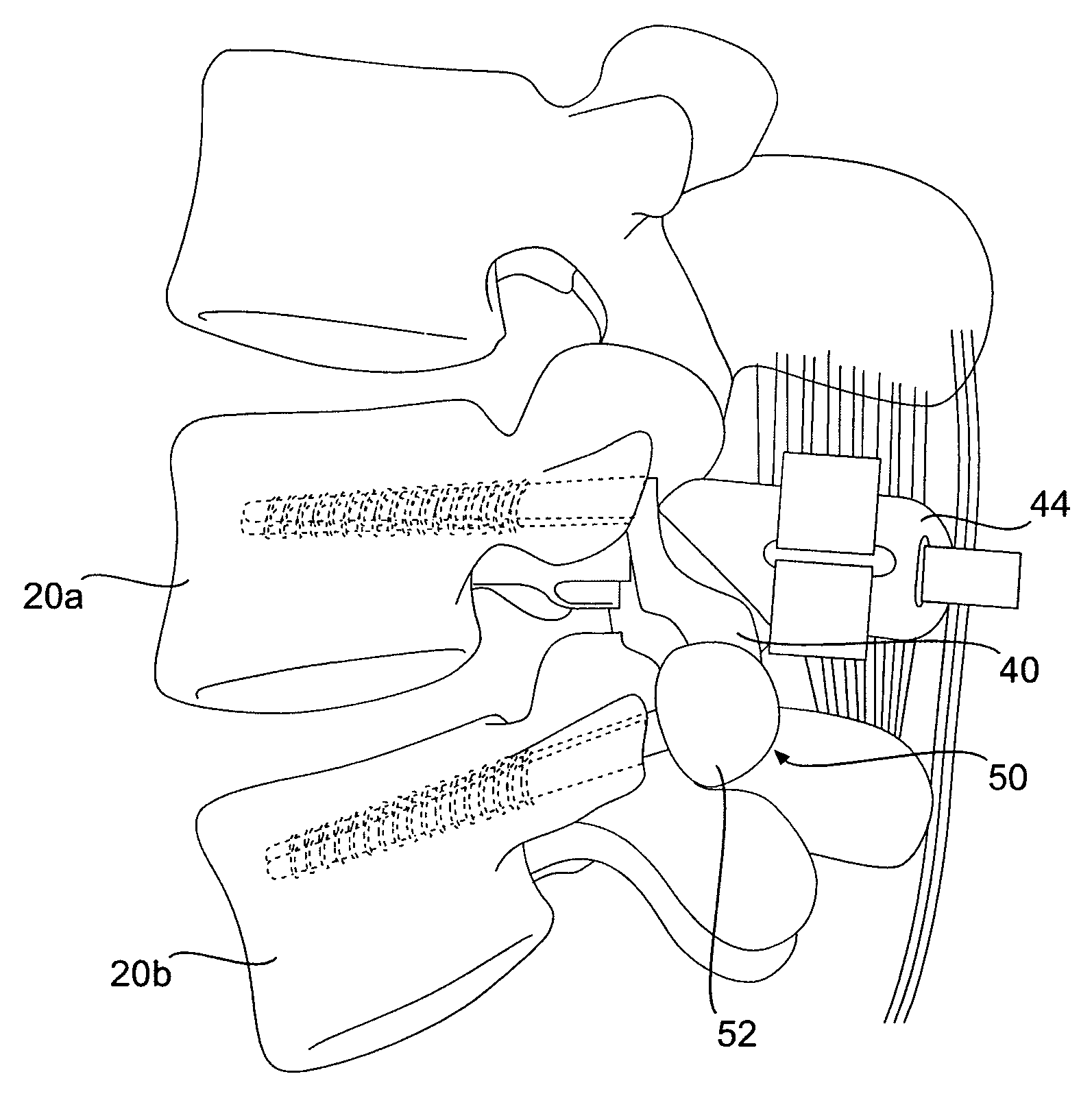 Prosthesis and method for replacing degenerative vertebral portions