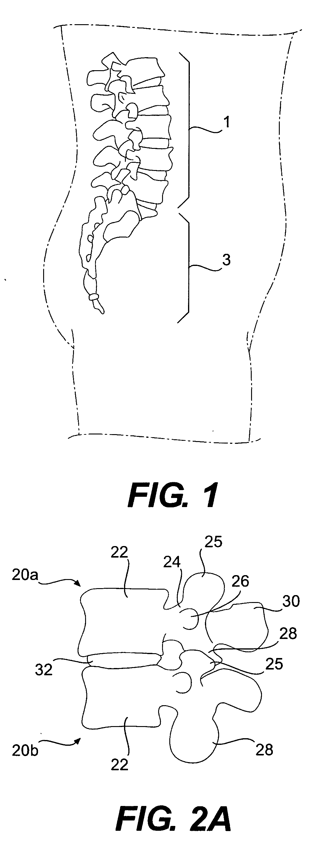 Prosthesis and method for replacing degenerative vertebral portions