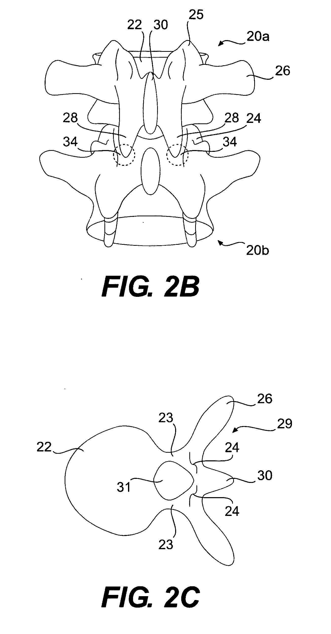 Prosthesis and method for replacing degenerative vertebral portions