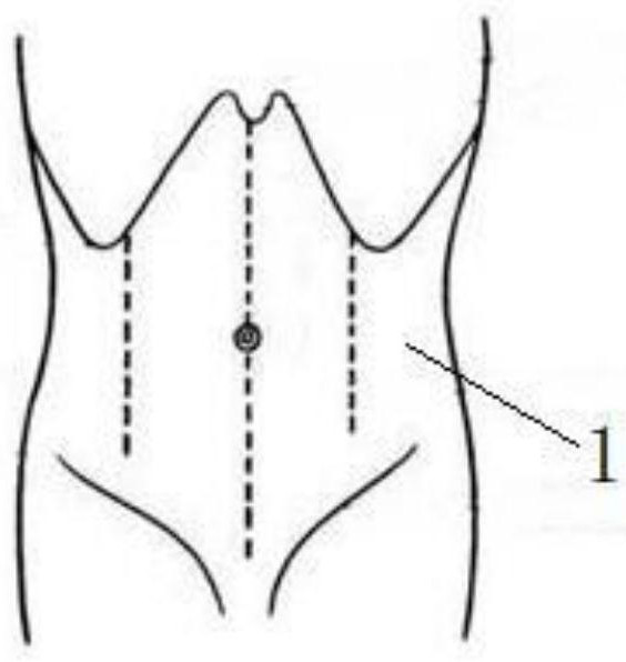 Abdomen model for anticoagulant subcutaneous injection training and training method thereof