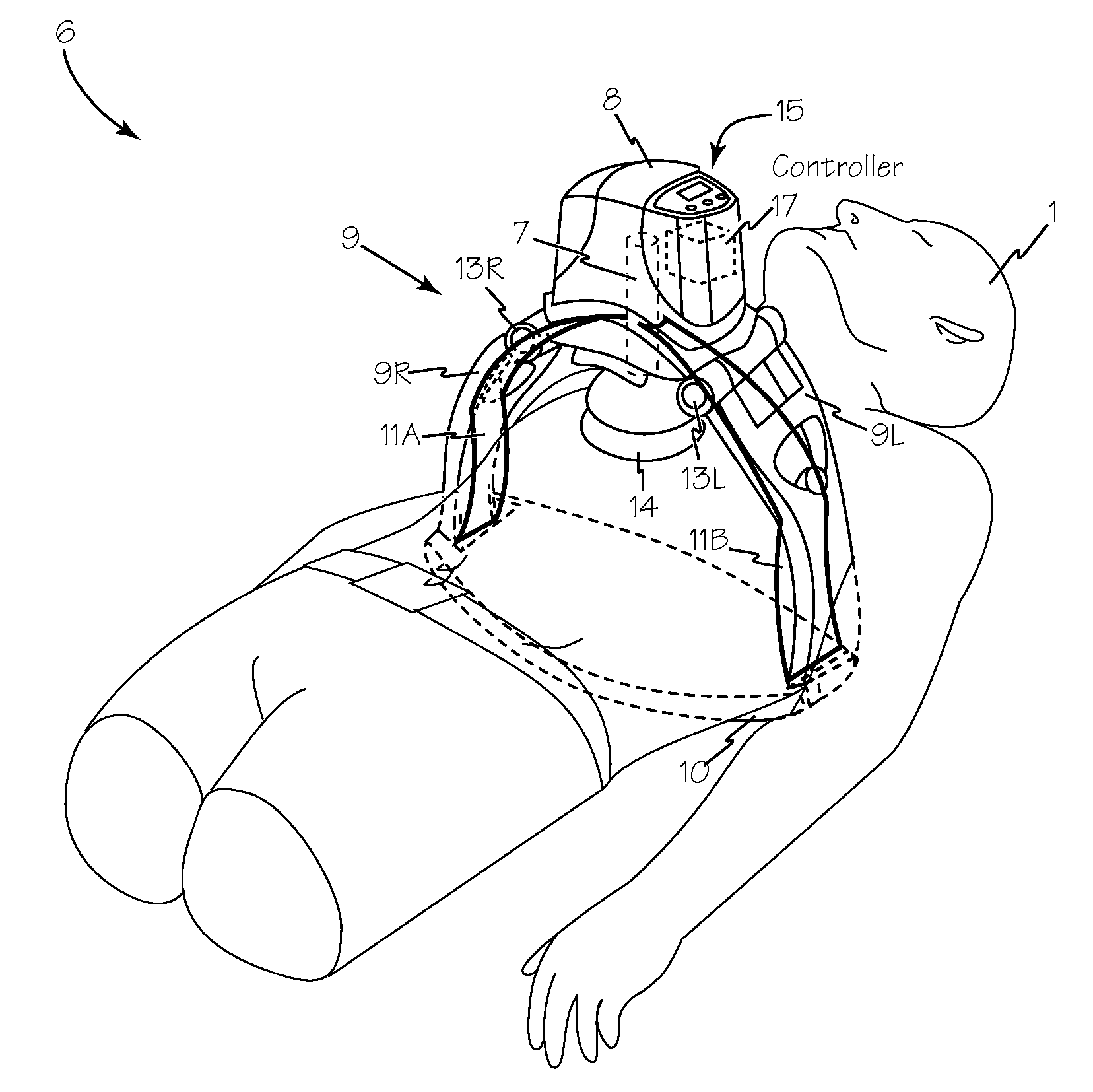 Chest compression device