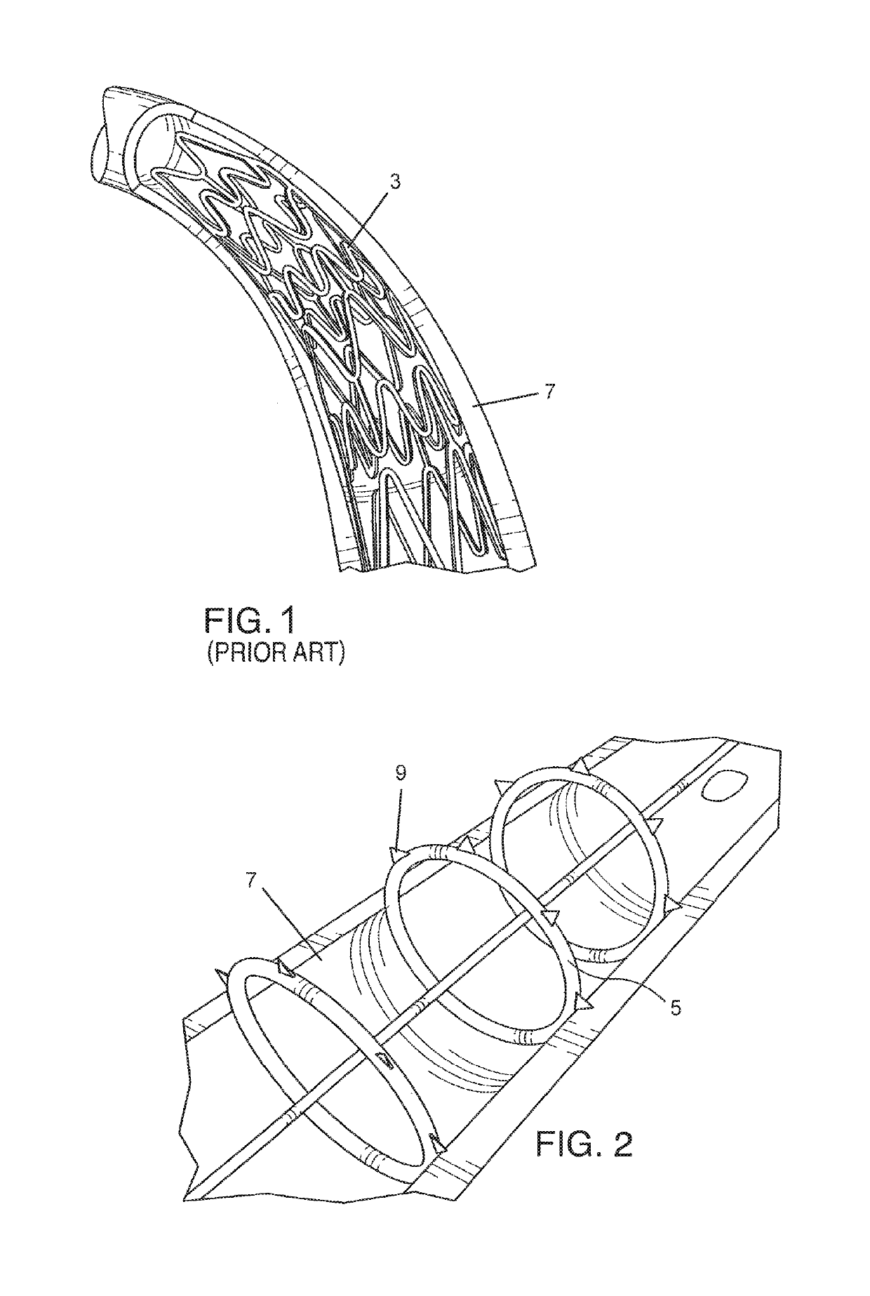 Endovascular impant