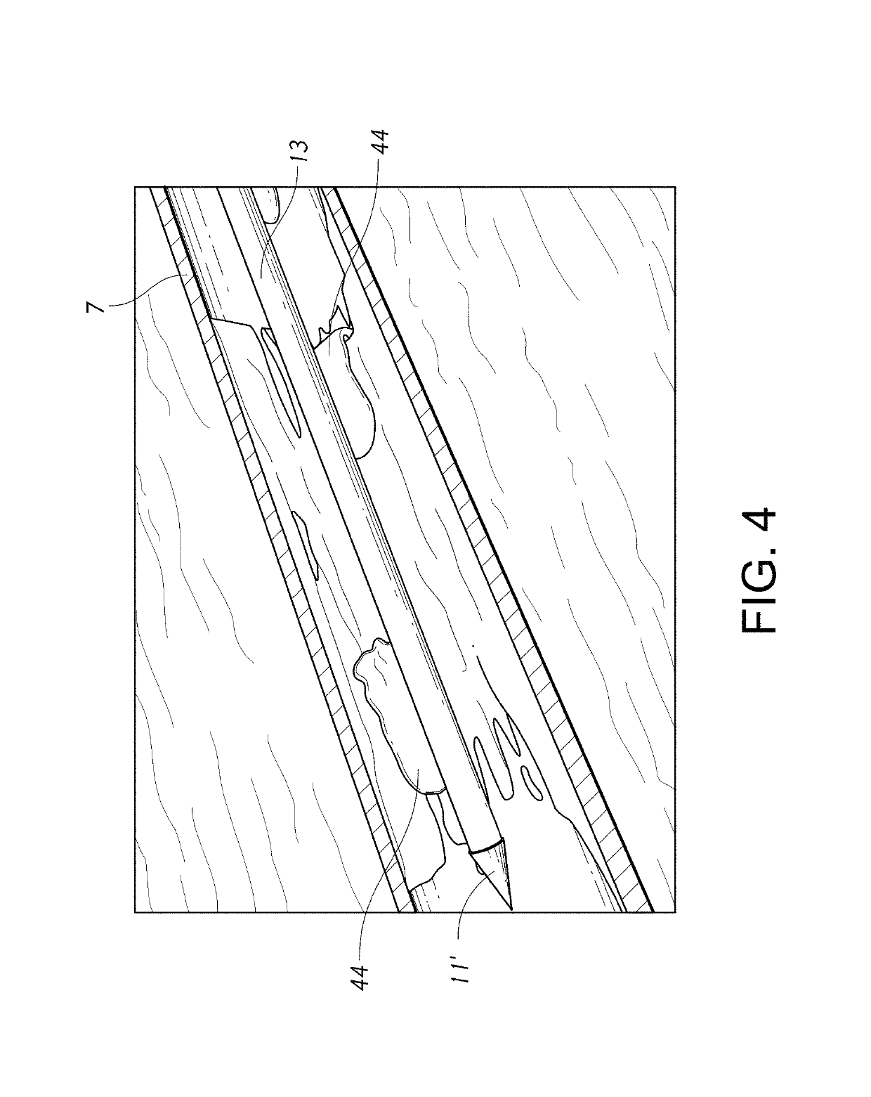 Endovascular impant