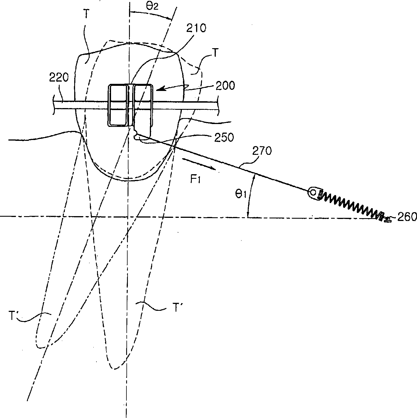 Orthodontic device