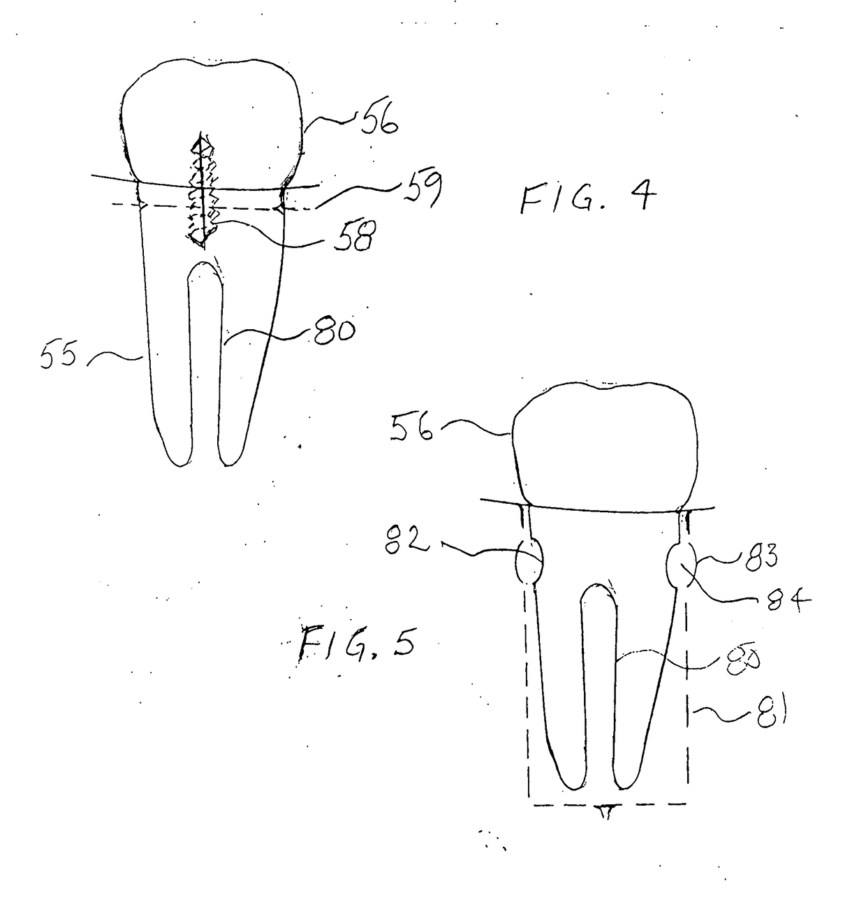 Anchoring system for prosthetics