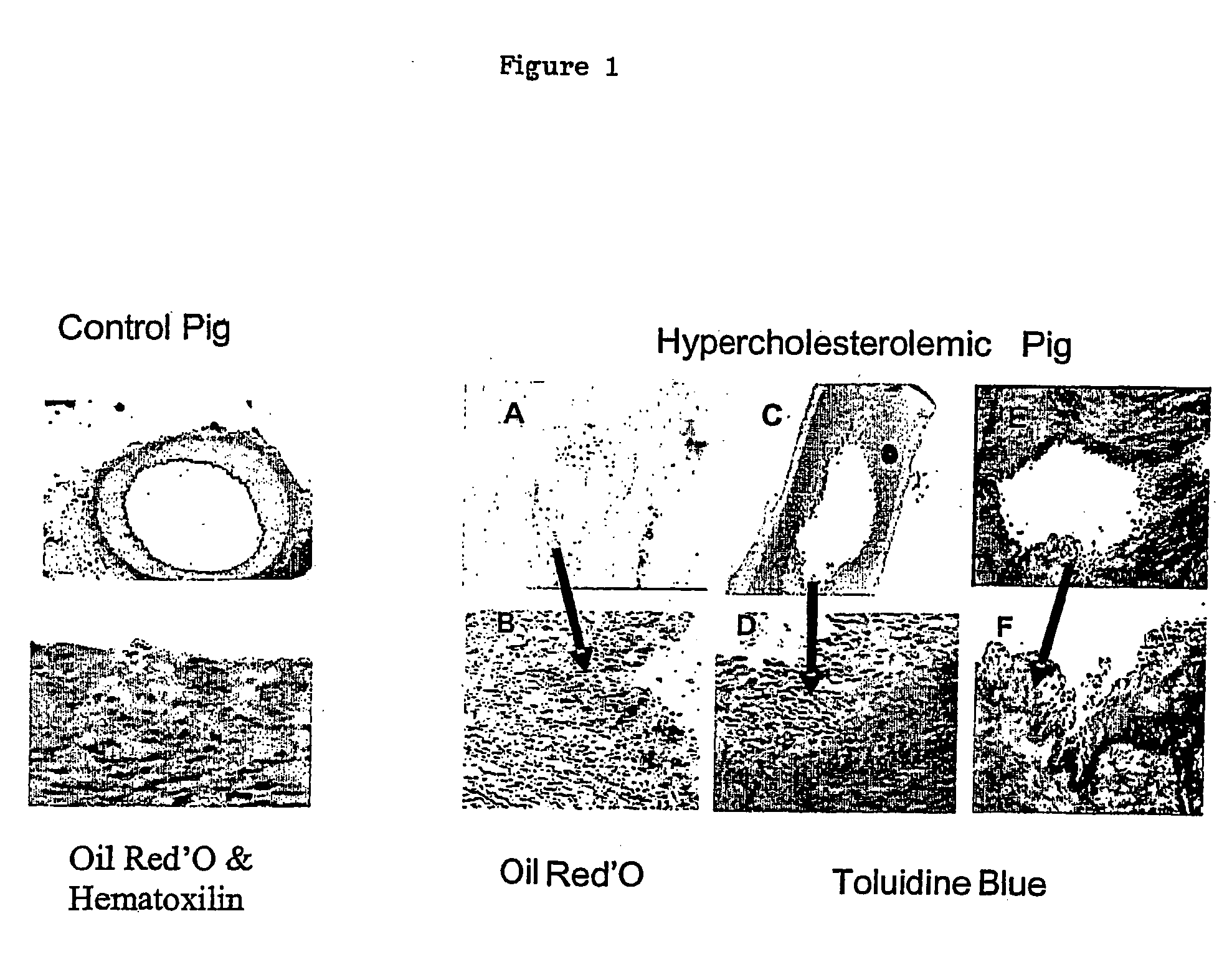 Methods and composition for identifying therapeutic agents of atherosclerotic plaque lesions