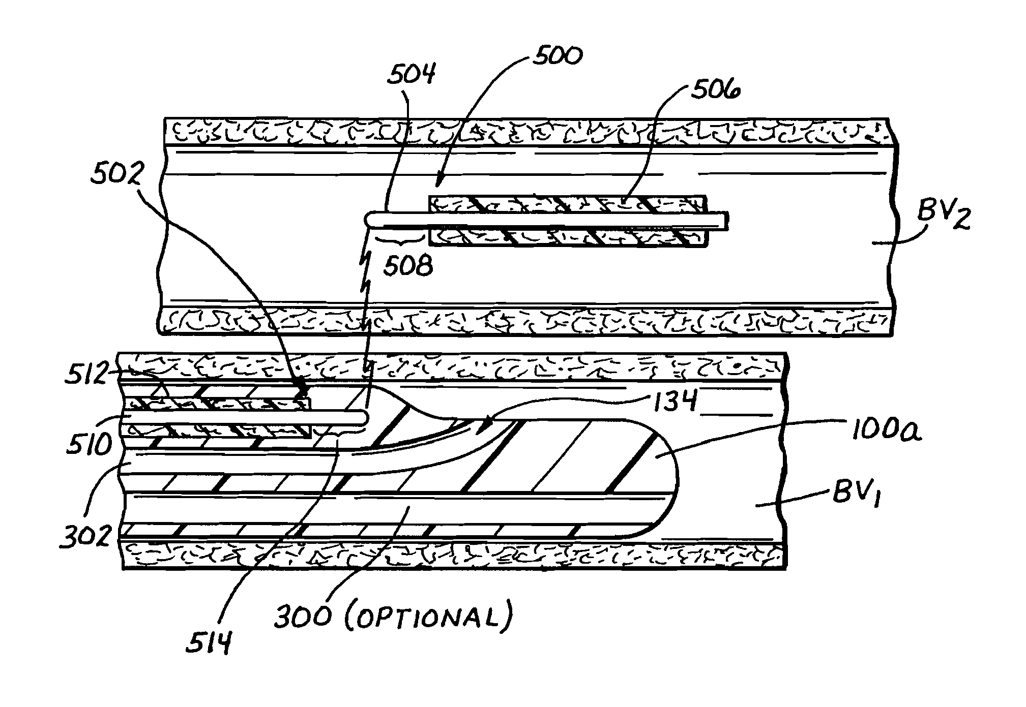 Catheters and related devices for forming passageways between blood vessels or other anatomical structures