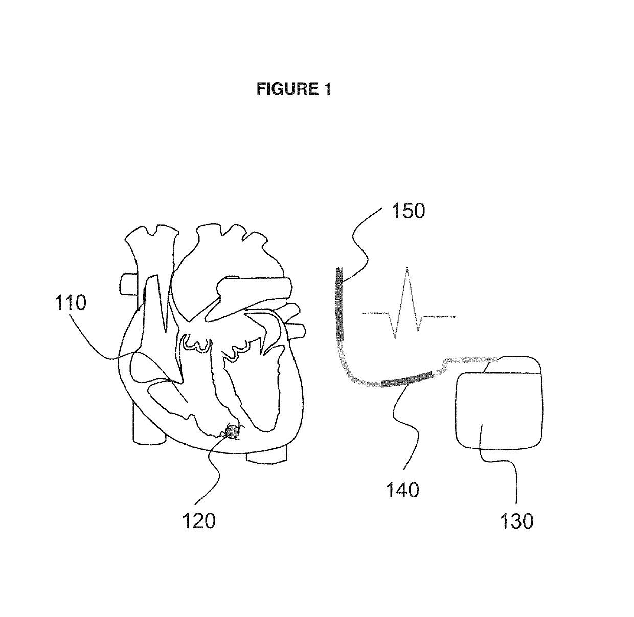 Implantable cardiac system having an R-spike amplifier