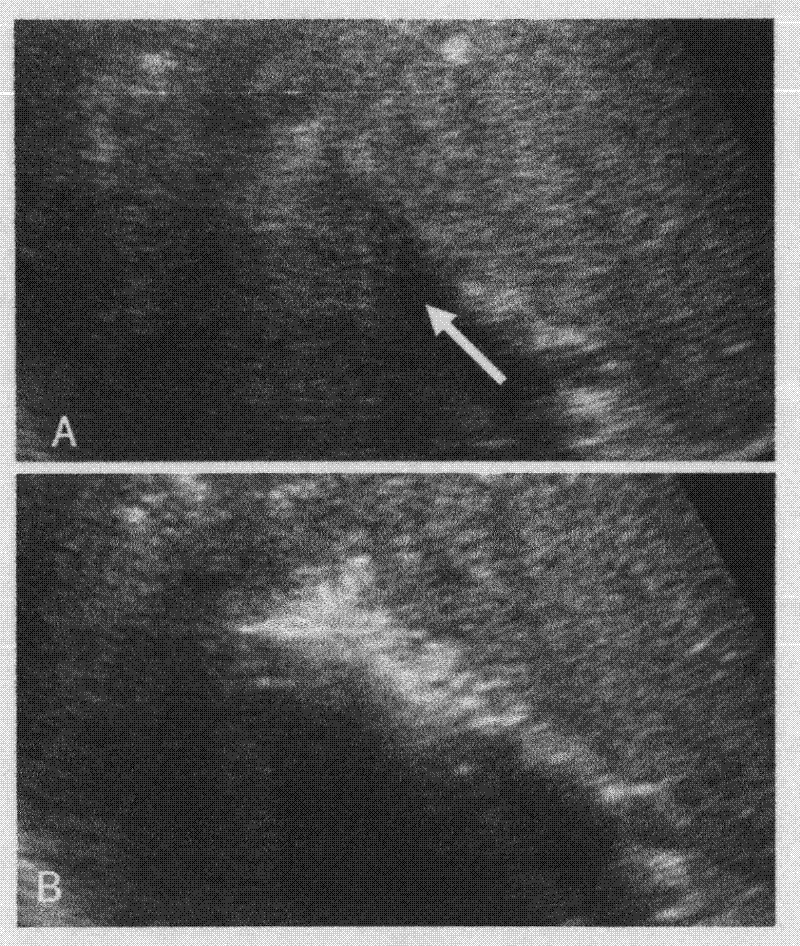 Absolute ethyl alcohol injection containing docetaxel and application thereof in preparing medicaments for treating tumors under ultrasonic guidance