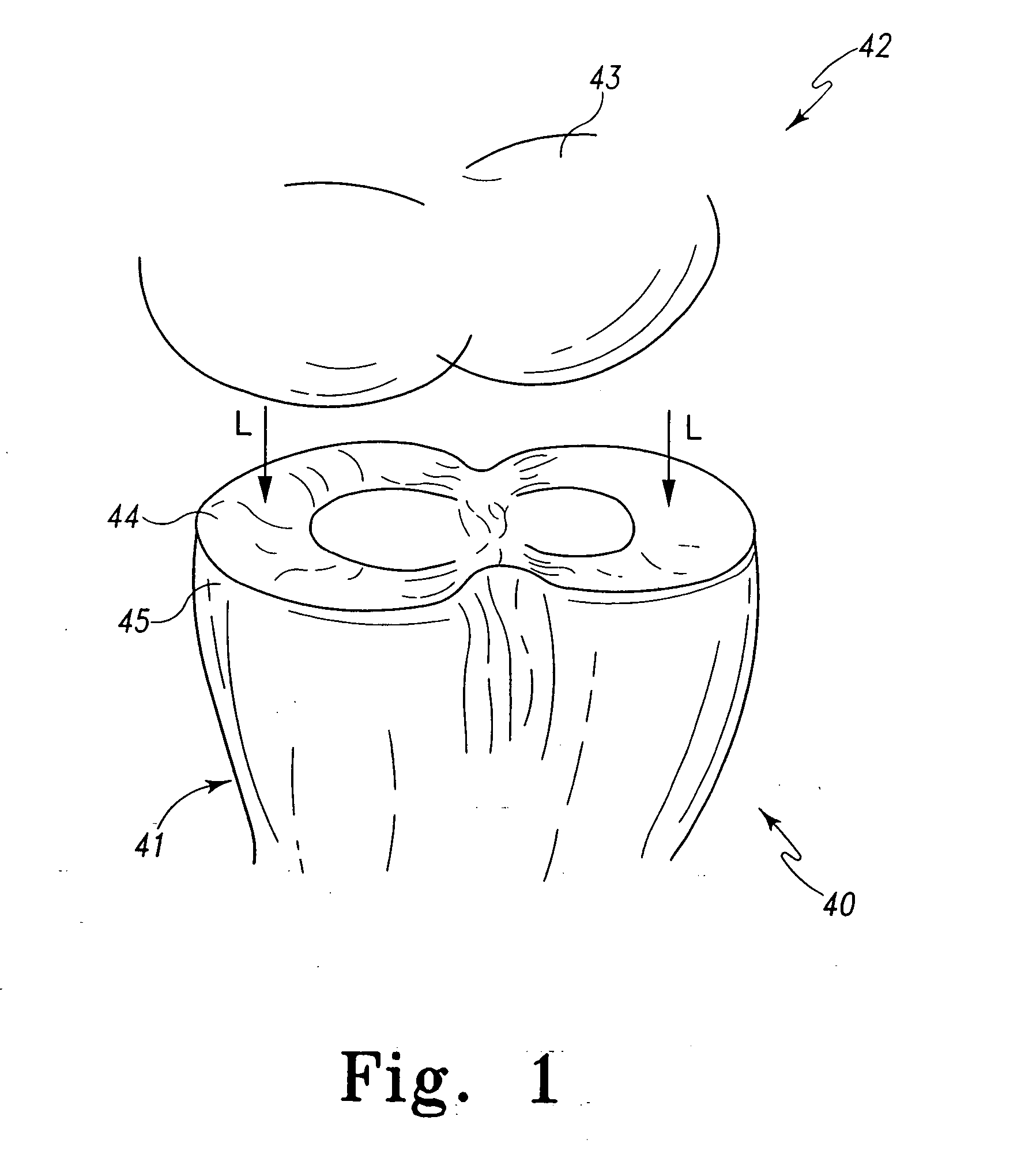 Implant device for cartilage regeneration in load bearing articulation regions