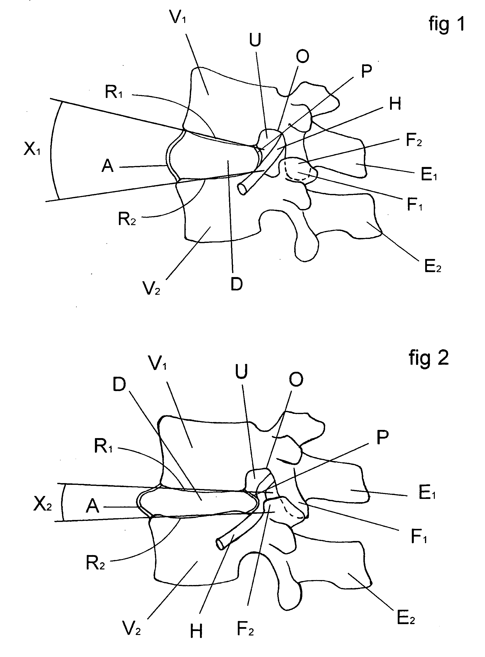 Method for correcting a deformity in the spinal column and its corresponding implant