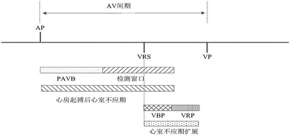 Method for eliminating high-frequency interference of implantable cardiac pacemaker AV interval inner ventricle