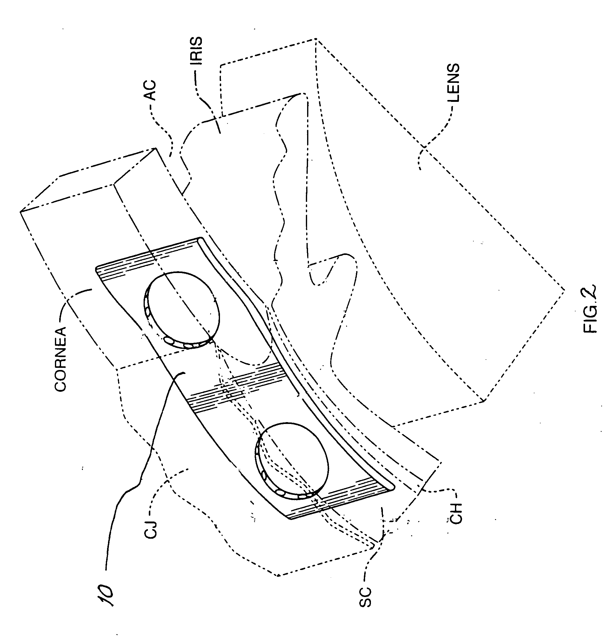 Shunt for the treatment of glaucoma